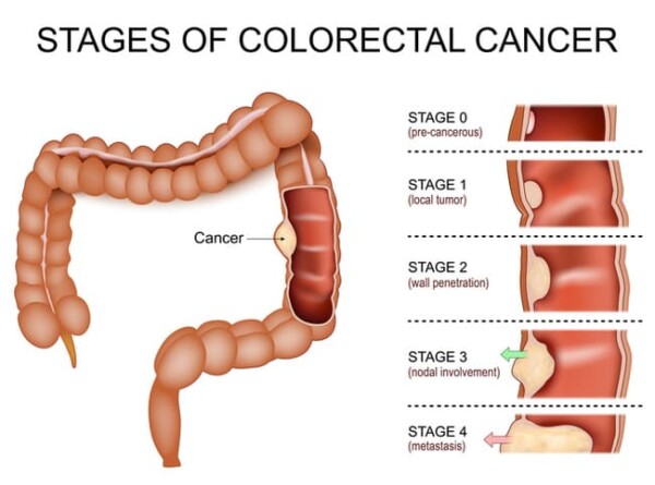 Illustration of the stages of colorectal cancer progression in the colon. The large intestine is shown with cross-sectional insets for each stage: Stage 0 (pre-cancerous, limited to the inner lining), Stage 1 (local tumor invading the wall), Stage 2 (deeper wall penetration), Stage 3 (nodal involvement with cancer spread to nearby lymph nodes), and Stage 4 (metastasis to distant sites). Arrows indicate advancement from early to advanced stages.